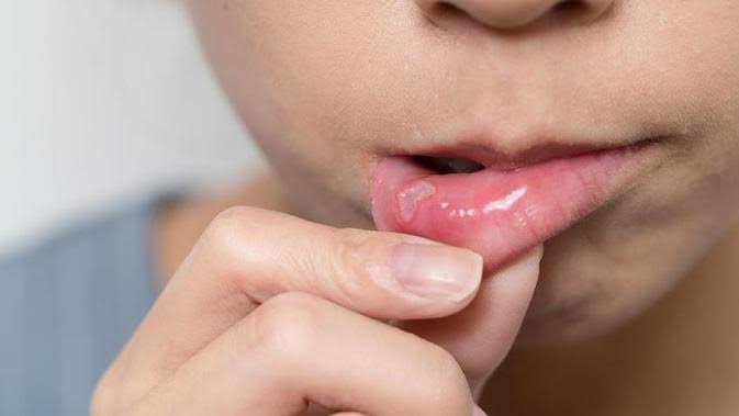 ilustrasi sakit sariawan